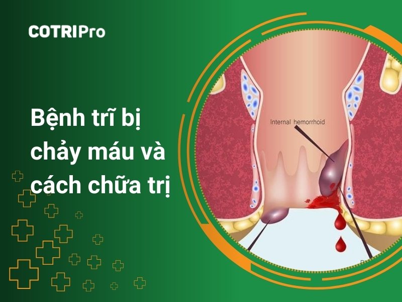 Bệnh trĩ bị chảy máu và cách chữa trị tình trạng nhẹ và nặng