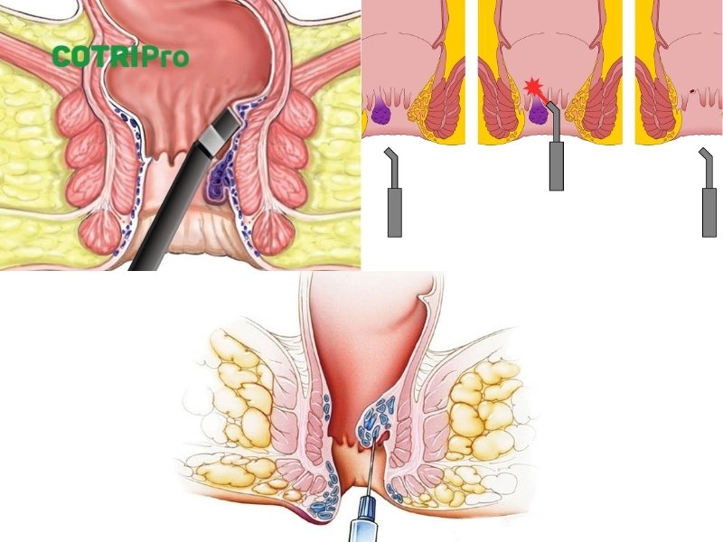 Thủ thuật chữa bệnh trĩ không cần phẫu thuật