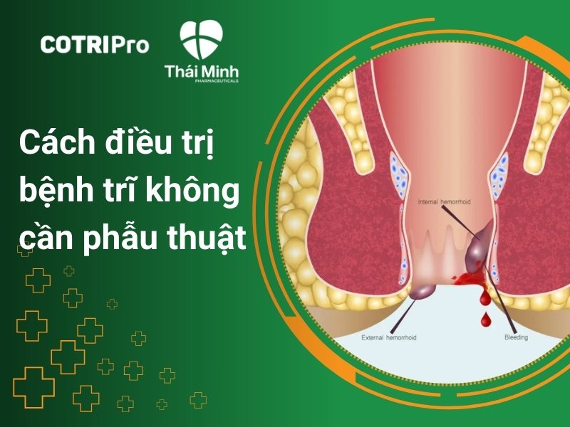 5 Cách điều trị bệnh trĩ không cần phẫu thuật hiệu quả, an toàn