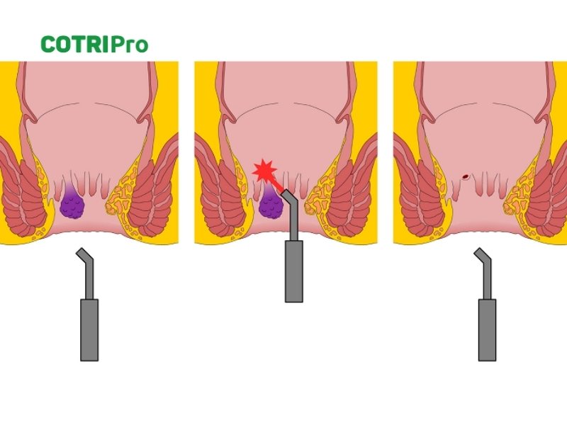 Phương pháp điều trị trĩ bằng laser