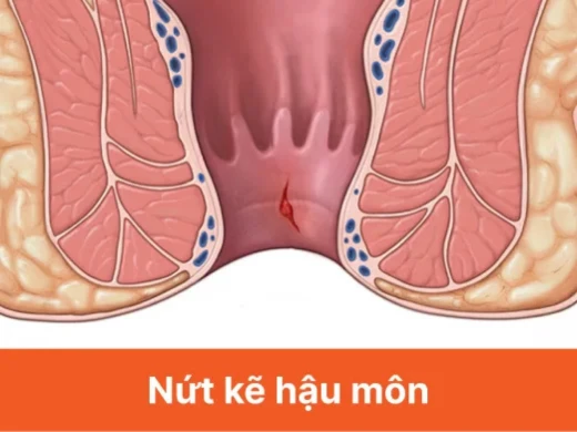 nut-ke-hau-mon.webp
