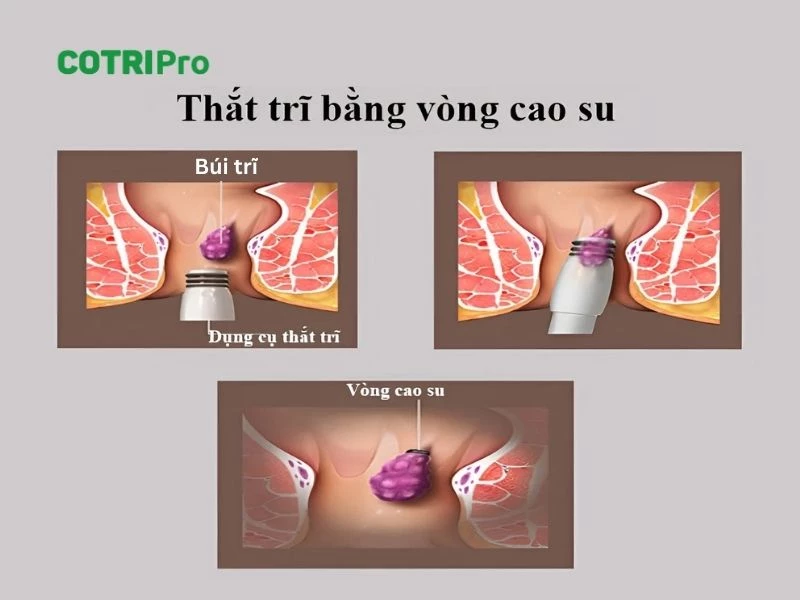 Thắt búi trĩ bằng vòng cao su làm teo búi