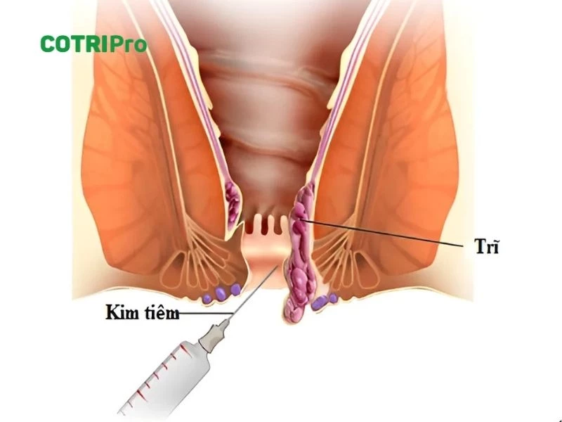 Tiêm xơ búi trĩ giúp búi trĩ teo lại