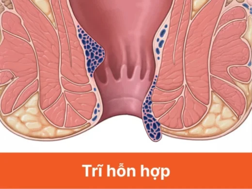 tri-hon-hop.webp