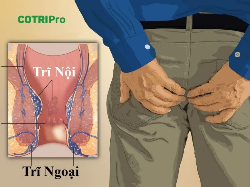 Trĩ ngoại có búi trĩ nằm rìa hậu môn