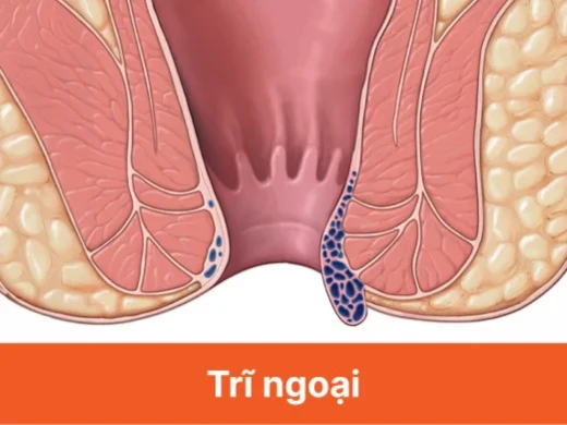 tri-ngoai.webp