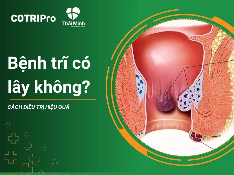 Bệnh trĩ có lây không? Cách điều trị hiệu quả