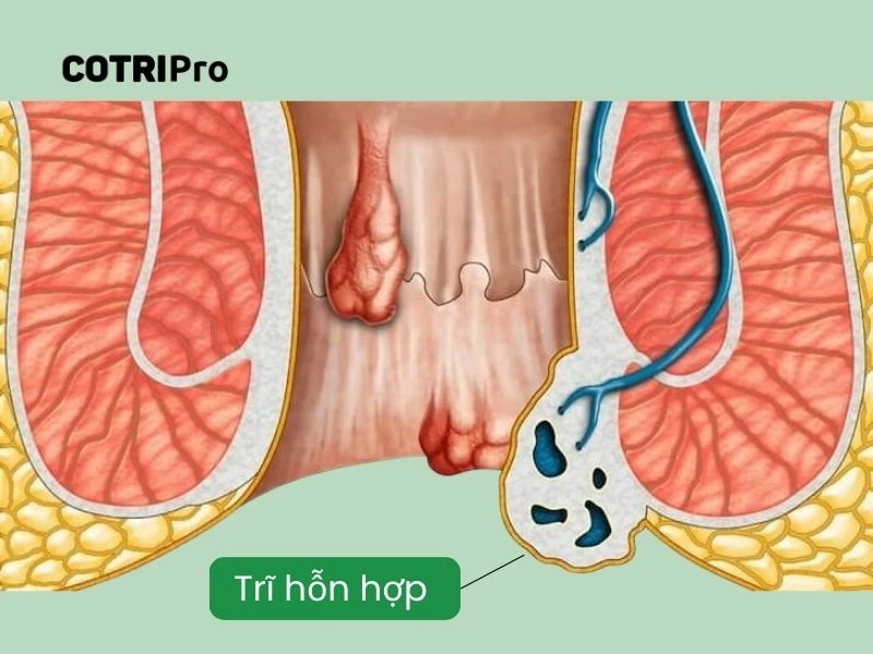 dấu hiệu trĩ hỗn hợp