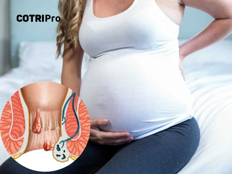 Thời điểm bà bầu dễ bị trĩ nhất
