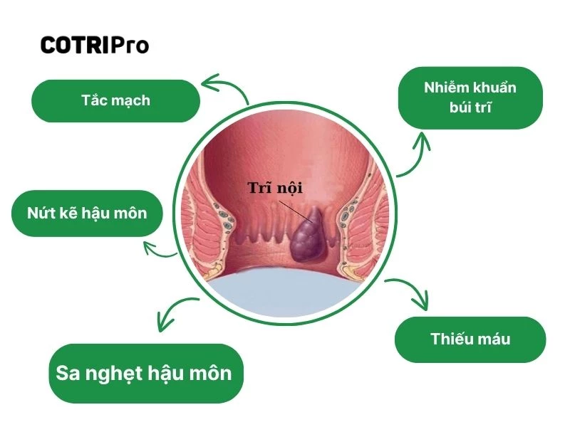 Biến chứng khi mắc bệnh trĩ nội