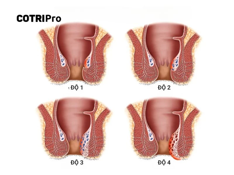 4 cấp độ của bệnh trĩ nội