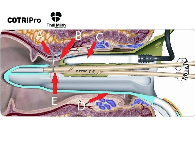 Cắt trĩ bằng kỹ thuật THD