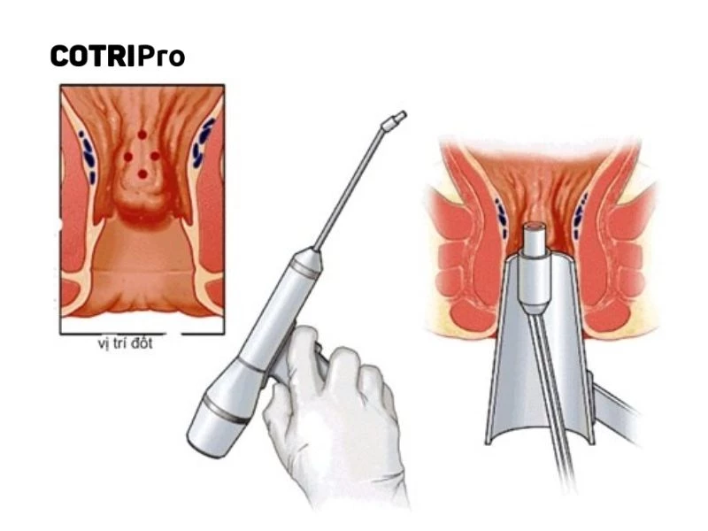  Điều trị trĩ độ 3 bằng phương pháp chích xơ