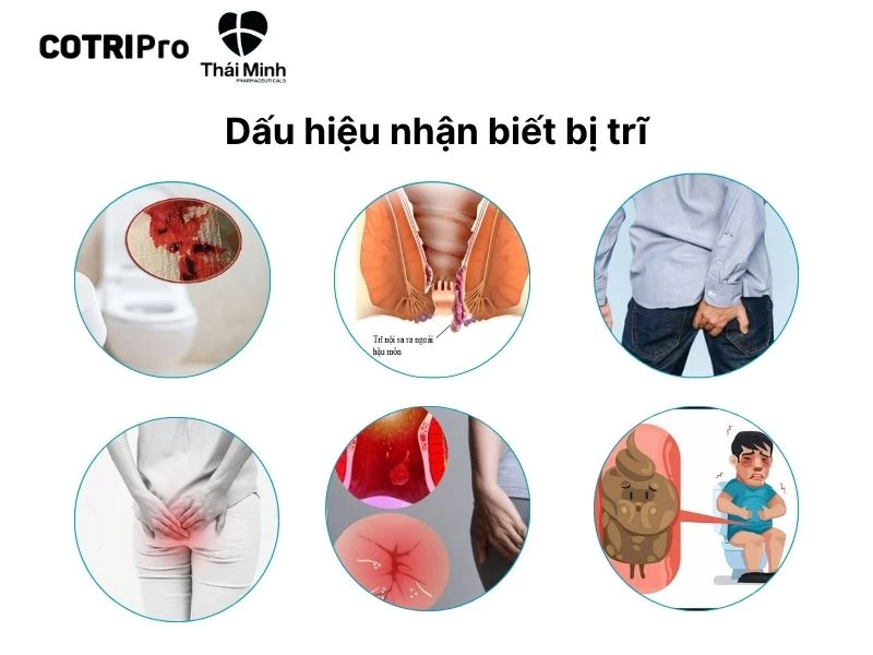 Các dấu hiệu chính của bệnh trĩ.
