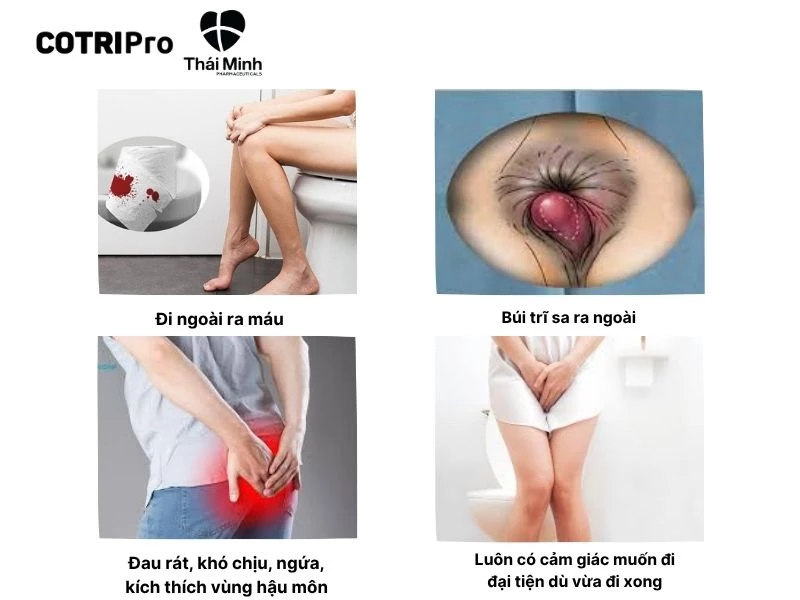 Dấu hiệu của bệnh trĩ