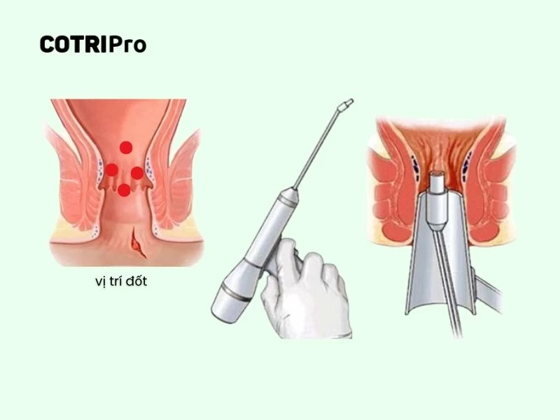 Ưu điểm phương pháp không xâm lấn