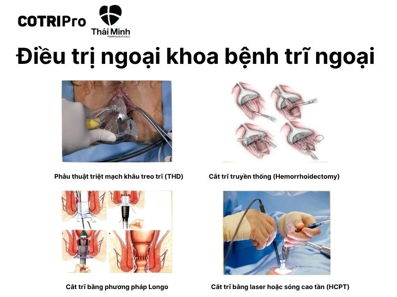 Điều trị trĩ ngoại bằng ngoại khoa