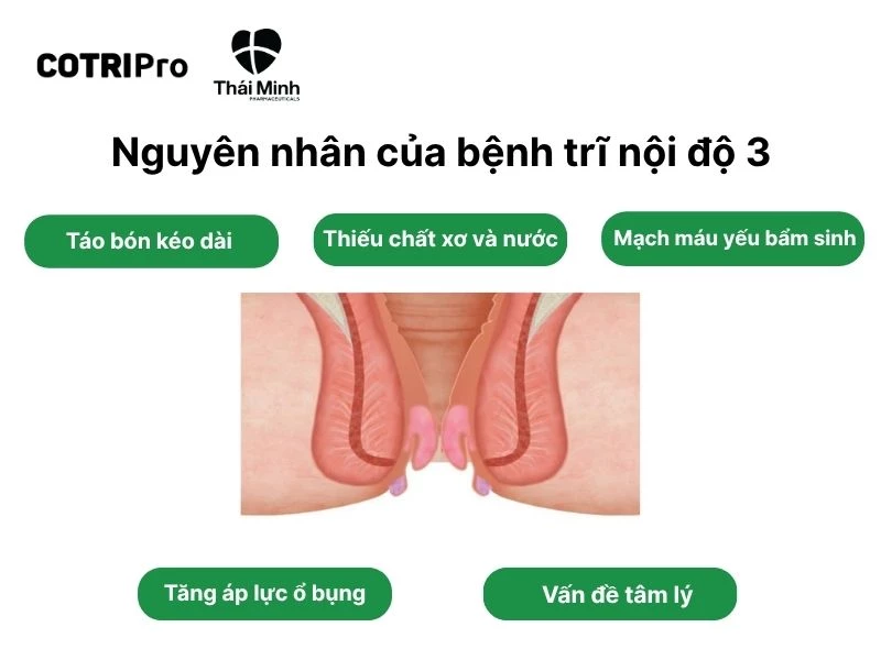 5 nguyên nhân gây trĩ nội độ 3