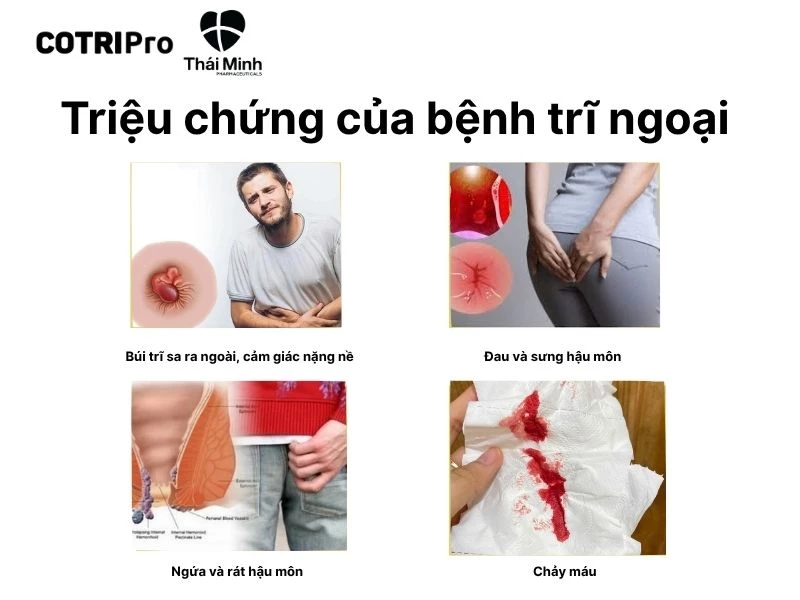 Triệu chứng nhận biết trĩ ngoại