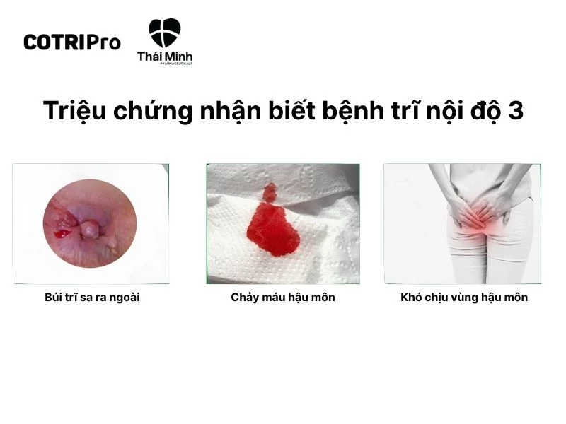 Triệu chứng nhận biết trĩ độ 3