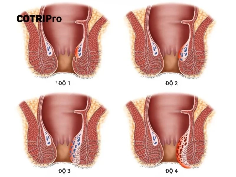 Phân biệt các cấp độ trĩ nội