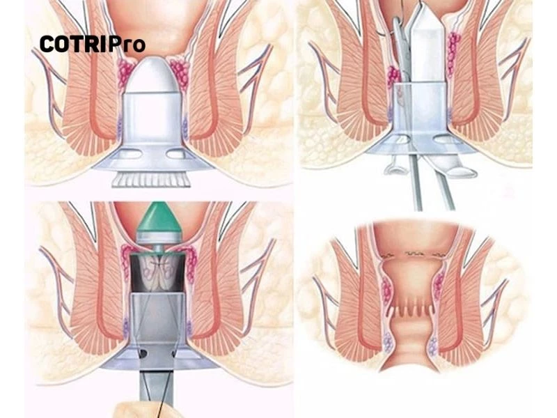 Trĩ nặng độ 4 cần phải phẫu thuật