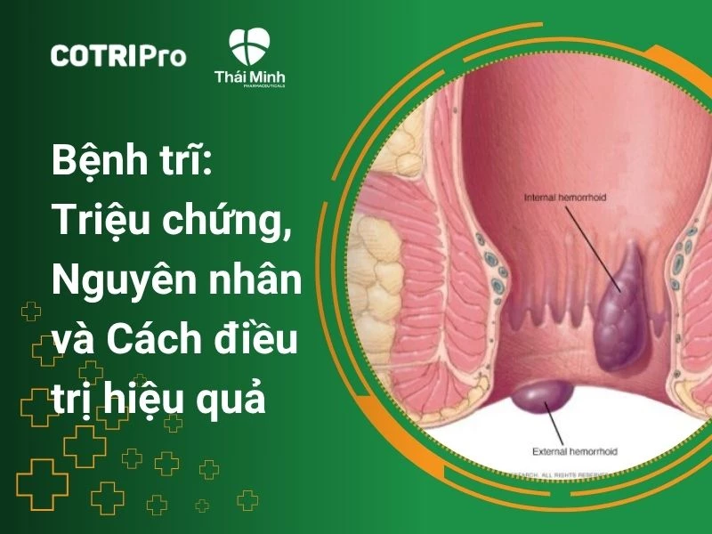 Bệnh trĩ: Triệu chứng, Nguyên nhân và Cách điều trị hiệu quả