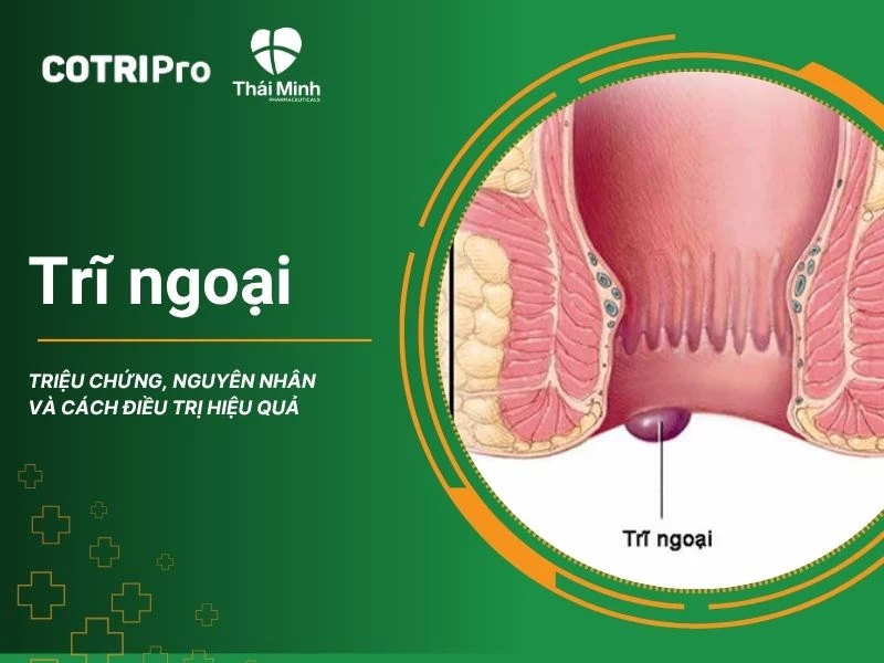 Trĩ ngoại: Triệu chứng, Nguyên nhân và Cách điều trị hiệu quả