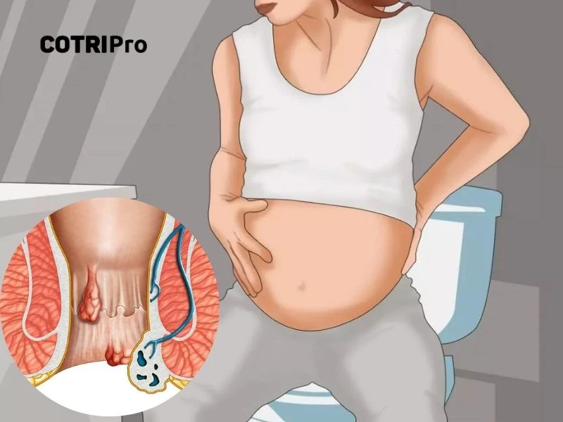 Tình trạng mắc bệnh trĩ của bà bầu