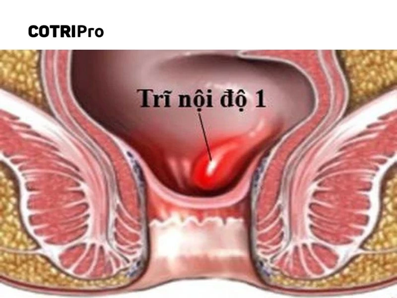Trĩ độ 1 là giai đoạn nhẹ của bệnh
