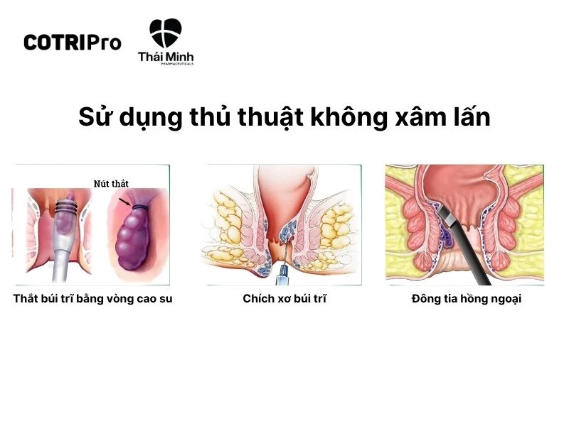 Phẫu thuật không xâm lấn trĩ nội độ 3