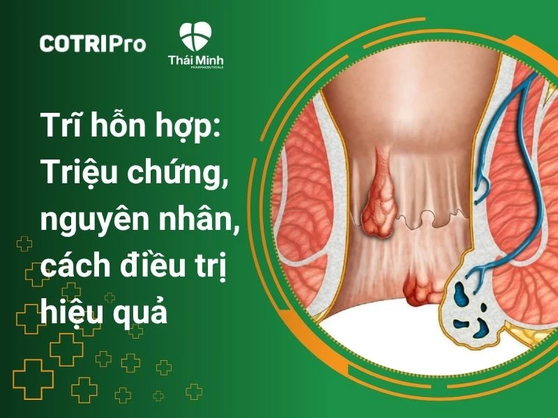 Trĩ hỗn hợp: Triệu chứng, Nguyên nhân và Cách điều trị hiệu quả