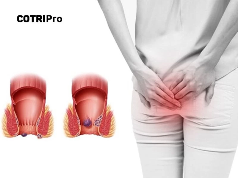 Trĩ là căn bệnh nguy hiểm