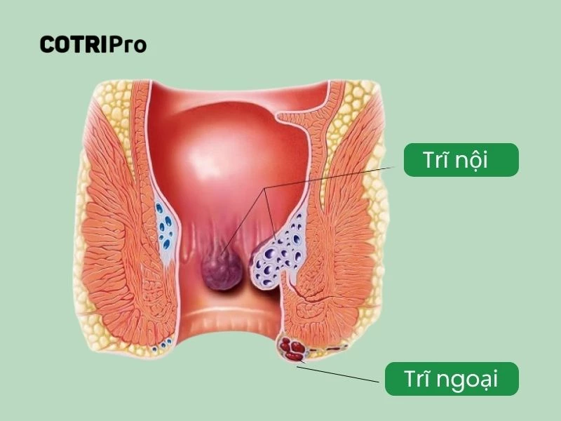 Dấu hiệu trĩ nội và trĩ ngoại