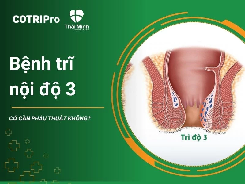 Giải đáp: Bệnh trĩ nội độ 3 có cần phẫu thuật không?