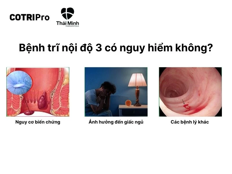 Bệnh trĩ độ nội 3 gây nhiều bất tiện