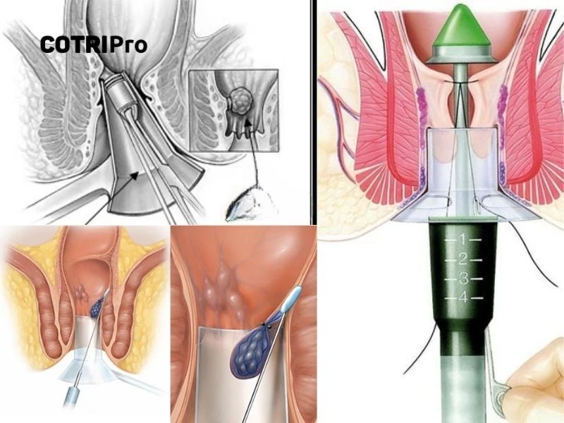 Phẫu thuật trĩ độ 4 cần ý kiến chuyên gia