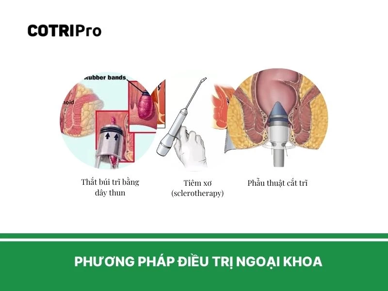 Điều trị bệnh trĩ cho bà bầu trở nặng