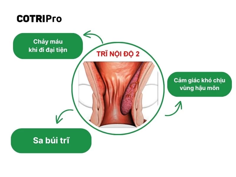 Chẩn đoán trĩ nội độ 2