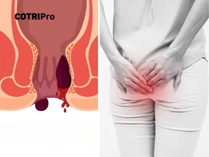 Trĩ nội độ 4 không thể nhét búi trĩ vào hậu môn
