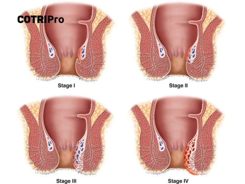 Trĩ nội có 4 cấp độ nguy hiểm