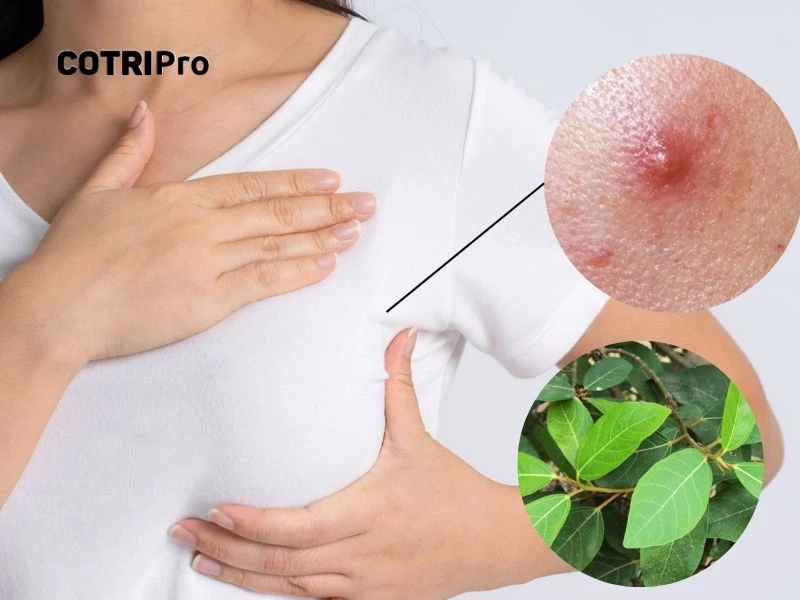 Bài thuốc hỗ trợ điều trị mụn nhọt, sưng vú từ lá sung