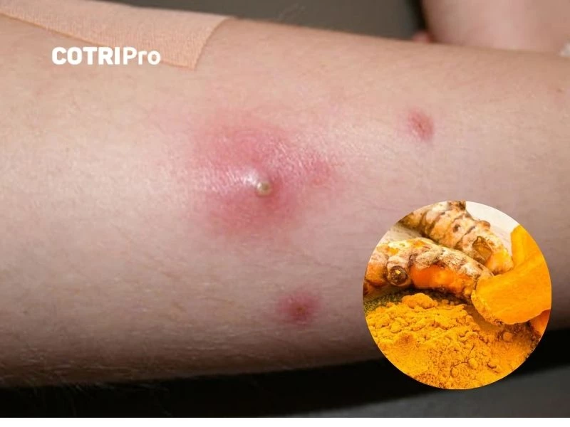 Bài thuốc chữa vết thương lở loét, mụn nhọt từ nghệ
