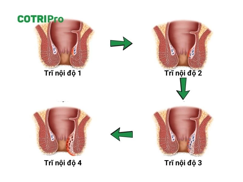 4 giai đoạn bệnh trĩ nội