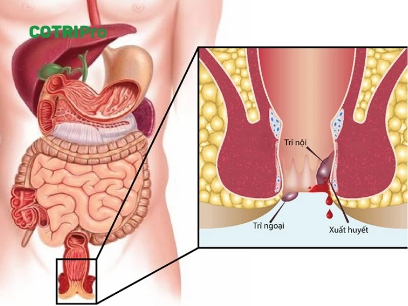 Tổng quan trĩ ngoại độ 1