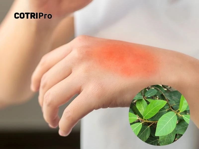 Bài thuốc hỗ trợ trị bỏng từ lá sung