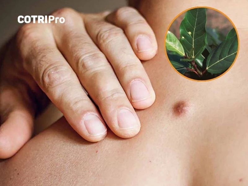 Bài thuốc từ lá sung trị nổi cục ở da
