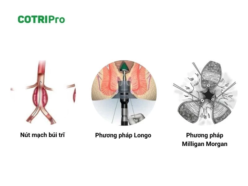 Phương pháp ngoại khoa trị trĩ chảy máu