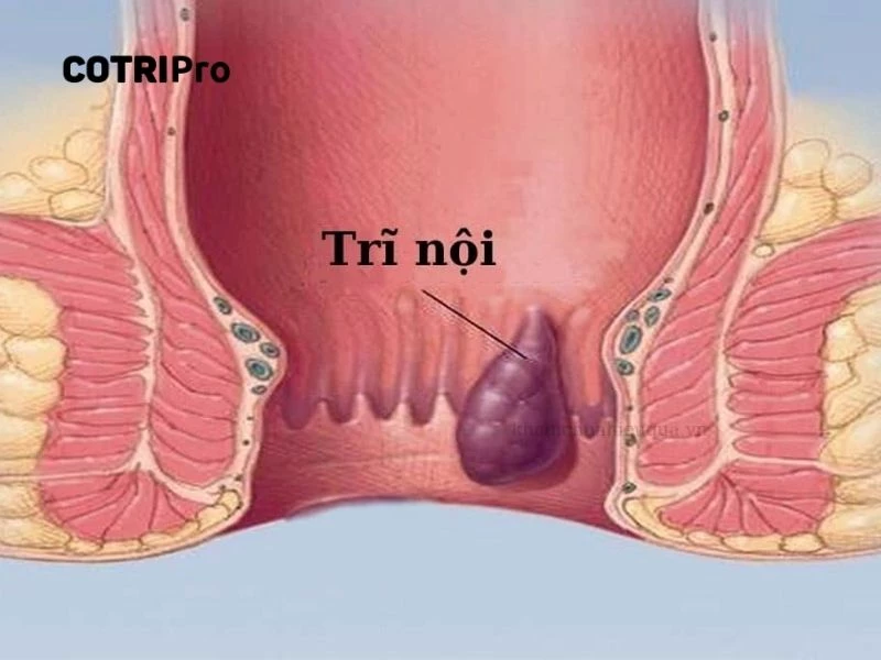 Búi trĩ nội nằm trên trong hậu môn