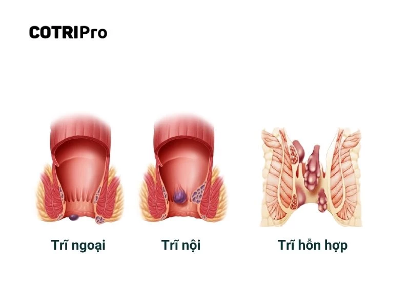 Bệnh trĩ gồm 2 loại